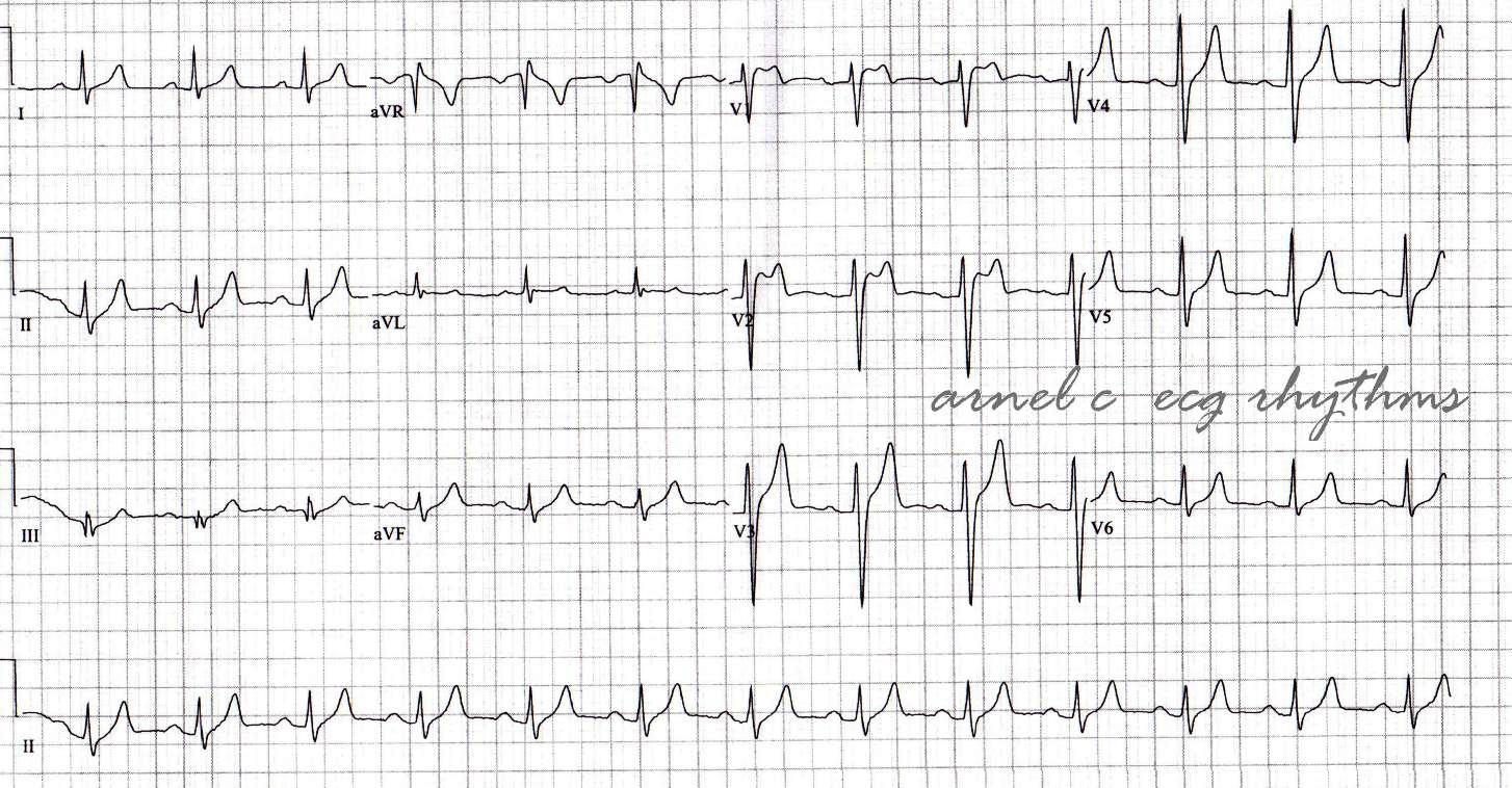 Sinus Rhythm ECG
